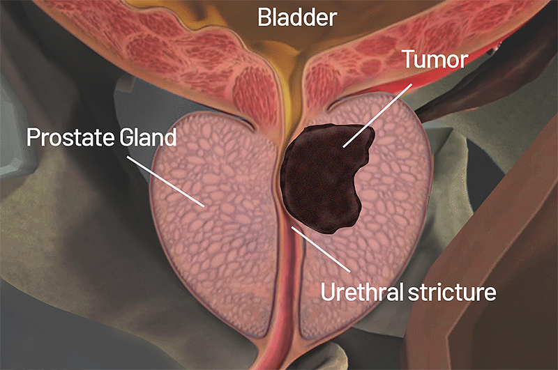 prostate-cancer-stages