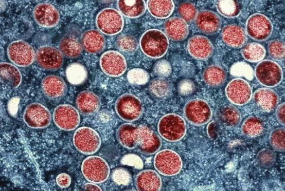 mpox ဗိုင်းရပ်စ်ကို အဏုကြည့်မှန်ပြောင်းဖြင့် တွေ့ရစဉ် (Photo: AP)