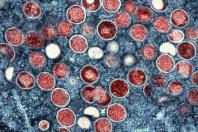 Mpox ရောဂါကို အဏုကြည့်မှန်ပြောင်းဖြင့် မြင်တွေ့ရစဉ်(Photo: AFP)