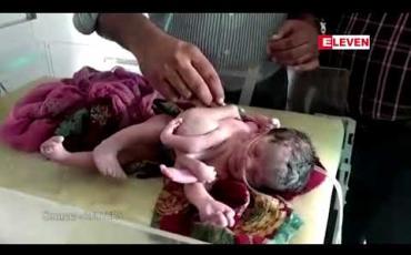 Embedded thumbnail for အိန္ဒိယတွင် ခြေလေးဖက်၊ လက်သုံးဖက်ပါသည့် ကလေးငယ်တစ်ဦး မွေးဖွားခဲ့