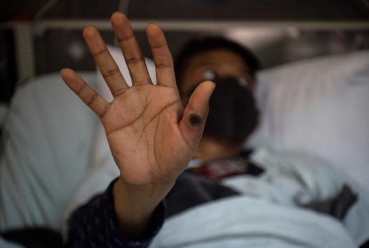 ၂၀၂၂ ခုနှစ် သြဂုတ်၁၆ ရက်က ပီရူးနိုင်ငံ လီမာမြို့တော်ရှိ အာဇိုဘစ်ပိုလိုရာဇာဆေးရုံတွင် လူနာတစ်ဦးက mpox ဗိုင်းရပ်စ်ကူးစက်မှုကြောင့်အနာဖြစ်နေသော လက်ကို ပြသနေစဉ်   (Photo – AFP)